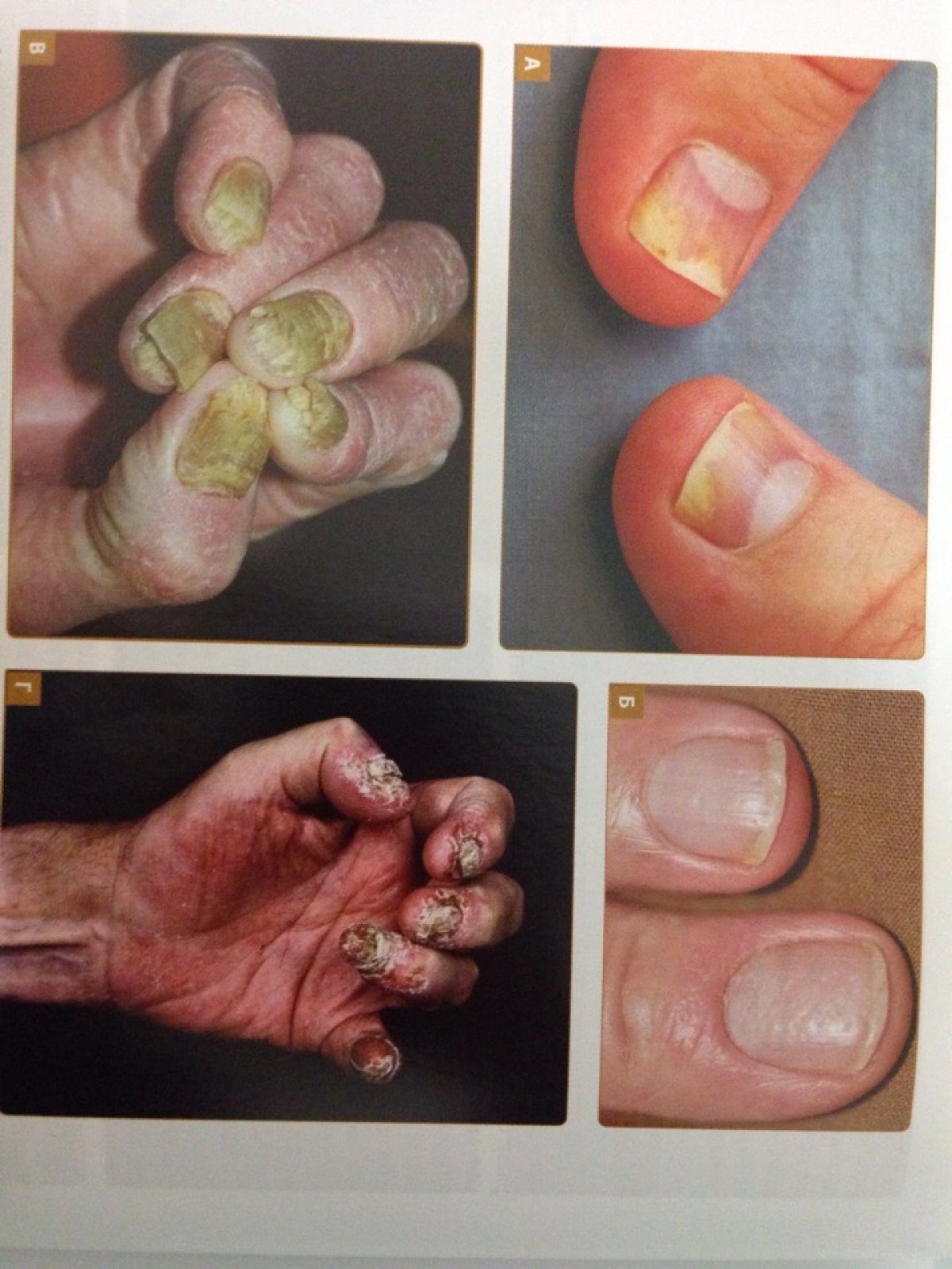 Викторина!) На какой фотографии грибок ногтей? Ответ нужно обосновать. Правильный ответ через сутки) Победителю приз!)