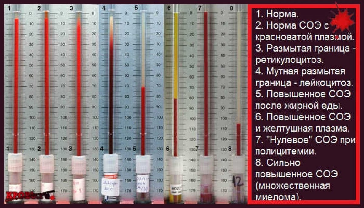 Соэ повышен причины. Скорость оседания эритроцитов СОЭ норма. Метод Панченкова СОЭ. СОЭ метод Панченкова норма у женщин. СОЭ 11мм.