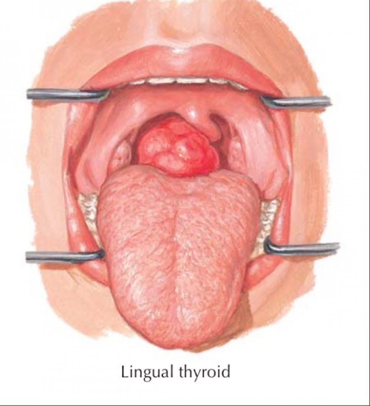 Щитовидная железа может располагаться не типично на шее, а , например, на языке. Иллюстрация из американского учебника по анатомии. Автор Ф.Неттер. Кто нибудь видел такое в жизни у пациентов?