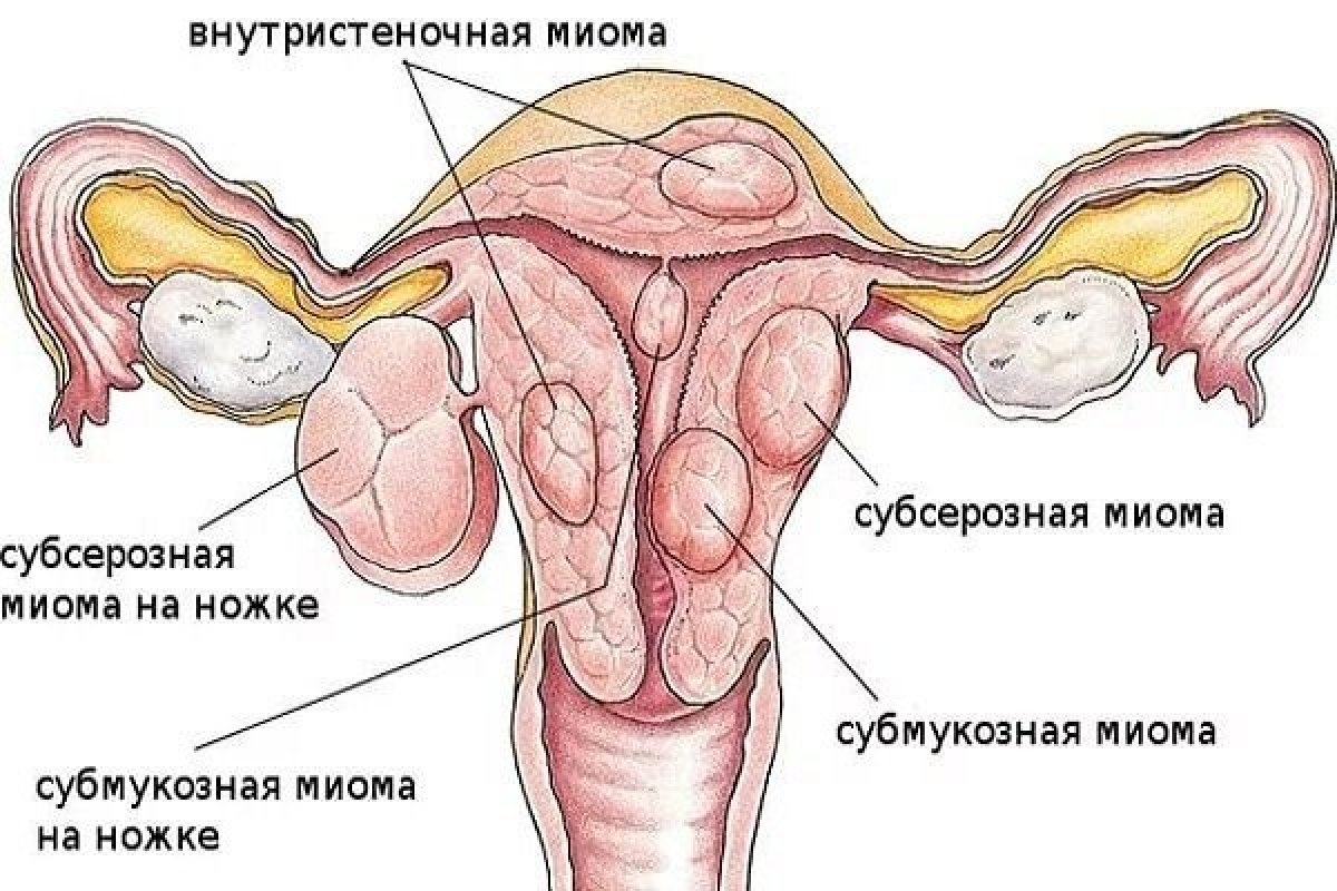 Симптомы в гинекологии