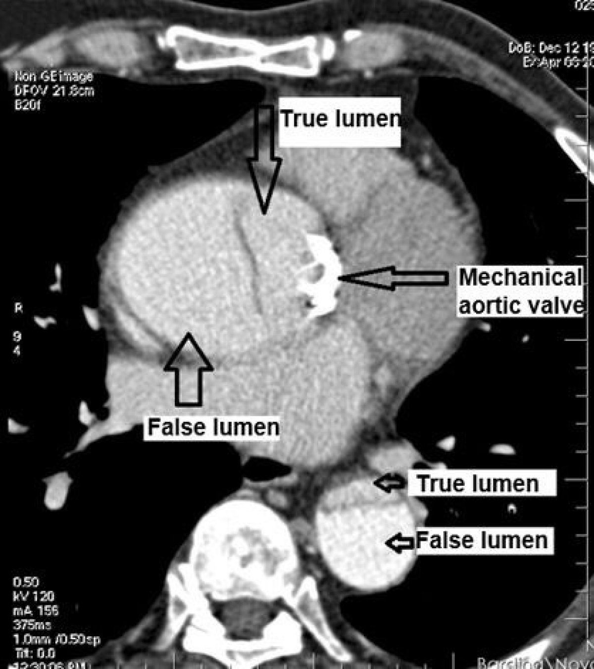 Клинический случай 72-летнего пациента с имплантированным механическим протезом аортального клапана сердца