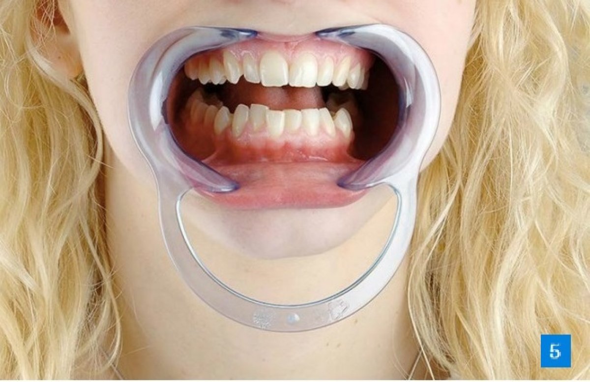 Во сколько закрывать рот. XR brands расширитель рта Cheek Retractor Dental mouth gag. Роторасширитель (ретрактор губной) большой 1шт Китай. Ротовой ретрактор оптрагейт. Ретрактор стоматологический силиконовый.