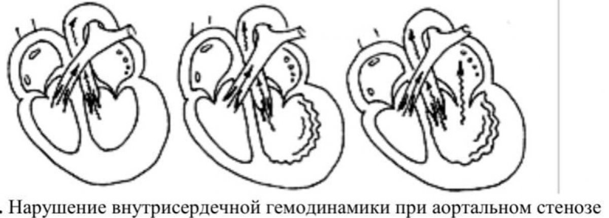 Сегодня мы расскажем об Аортальном пороке сердца ❤️