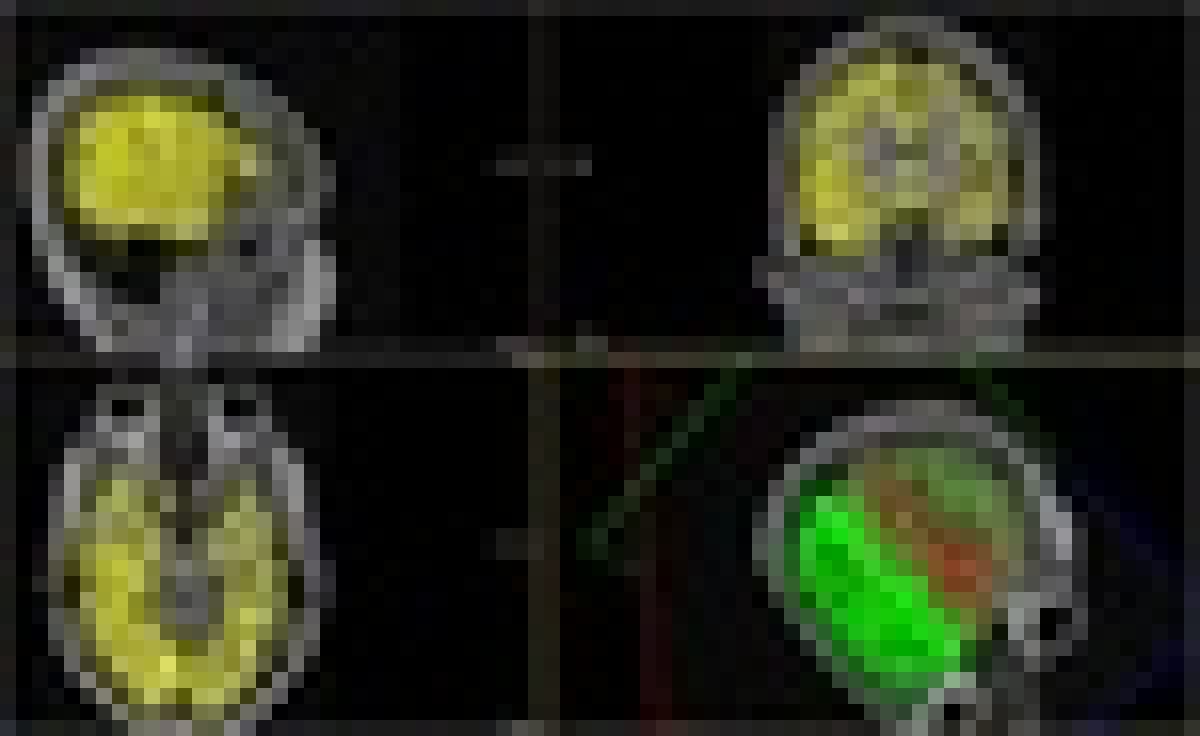📌 По данным всемирной организации здравоохранения более 400 миллионов человек во всем мире живут с диагнозом сахарный диабет. 📌 По данным всемирной организации здравоохранения более 400 миллионов человек во всем мире живут с диагнозом сахарный диабет.