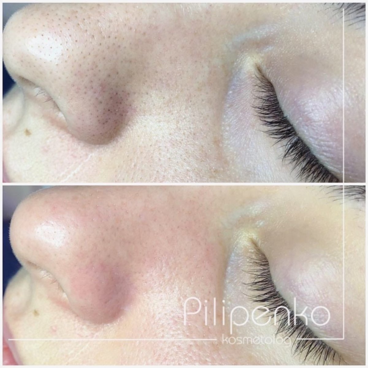 ✅Специально для тебя, студент медицинского университета, крутейший информативный курс "косметолог-эстетист" в школе https://vk.com/pilipenkoschool!